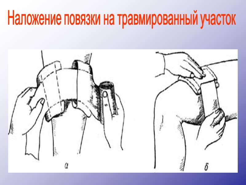 Наложение повязки на травмированный участок